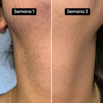 SkinUp Pro | Láser Permanente