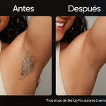 SkinUp Pro | Láser Permanente