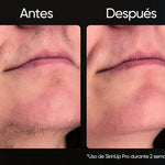 SkinUp Pro | Láser Permanente
