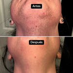 SkinUp Pro | Láser Permanente